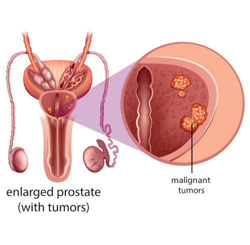 Enlarged Prostate